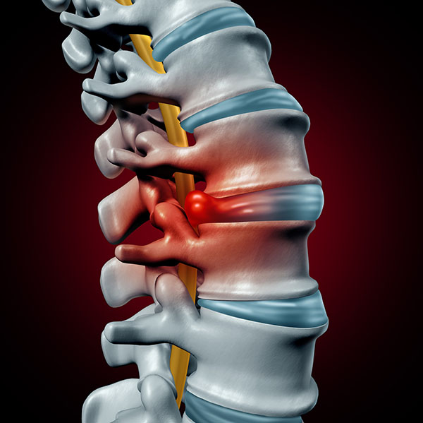 herniated disc, neck pain, portland neurosurgeons, neurosurgeons portland, spine pain relief, back pain relief