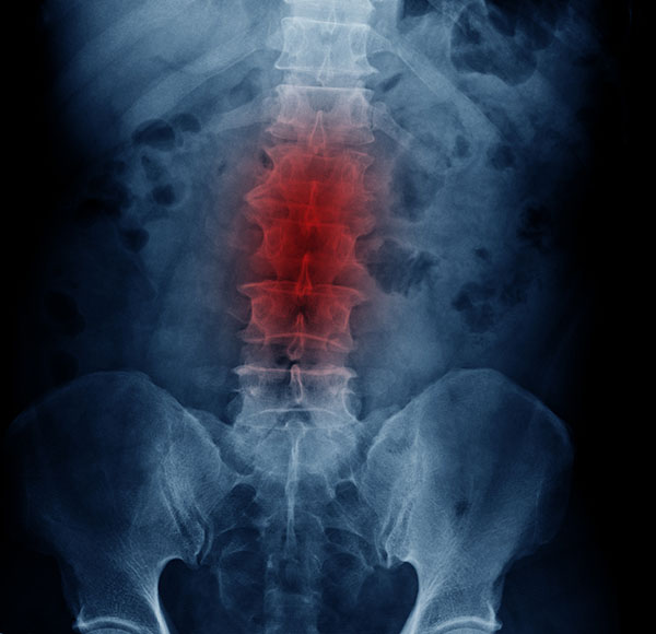 degenerated disc disease, back pain, portland neurosurgeons, neurosurgeons portland, spine pain relief, back pain relief