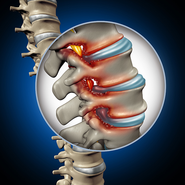 medical illustration showing spinal stenosis in lower back